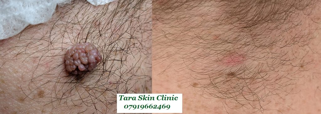 Before and after advanced skin blemish removal Seborrhoeic keratoses, warts, treatment at Tara Skin Clinic in Newmarket Suffolk. service for Ely, Soham, Cambridge, Redlodg, Mildenhall, Lakenheath.

