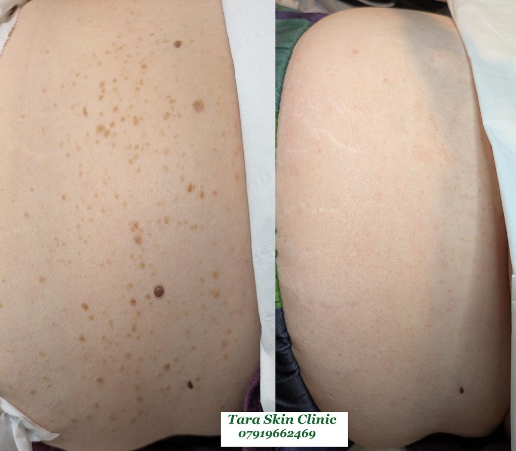 Before and after advanced skin blemish removal Seborrhoeic keratoses, warts, treatment at Tara Skin Clinic in Newmarket Suffolk. service for Ely, Soham, Cambridge, Redlodg, Mildenhall, Lakenheath.