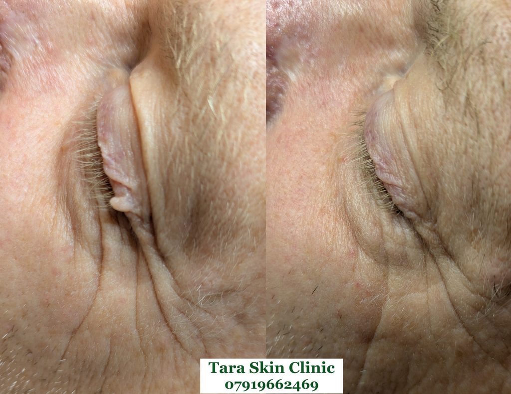 Before and after advanced eye skin tag removal treatment at Tara Skin Clinic in Newmarket Suffolk. Cover Cambridge, Soham, Ely, Middlehall, Lakenheath.