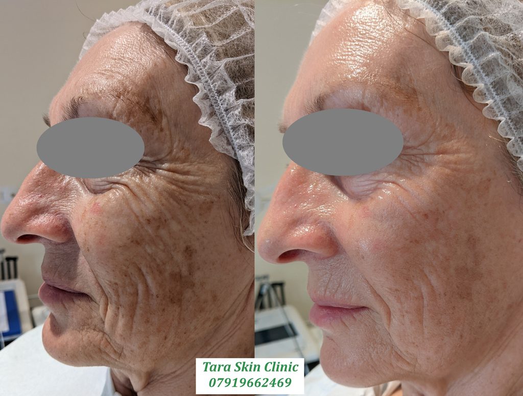 Before and after advanced skin anti aging and rejuvenation treatment at Tara Skin Clinic in Newmarket Suffolk covering Ely, Soham, Mildenhall
