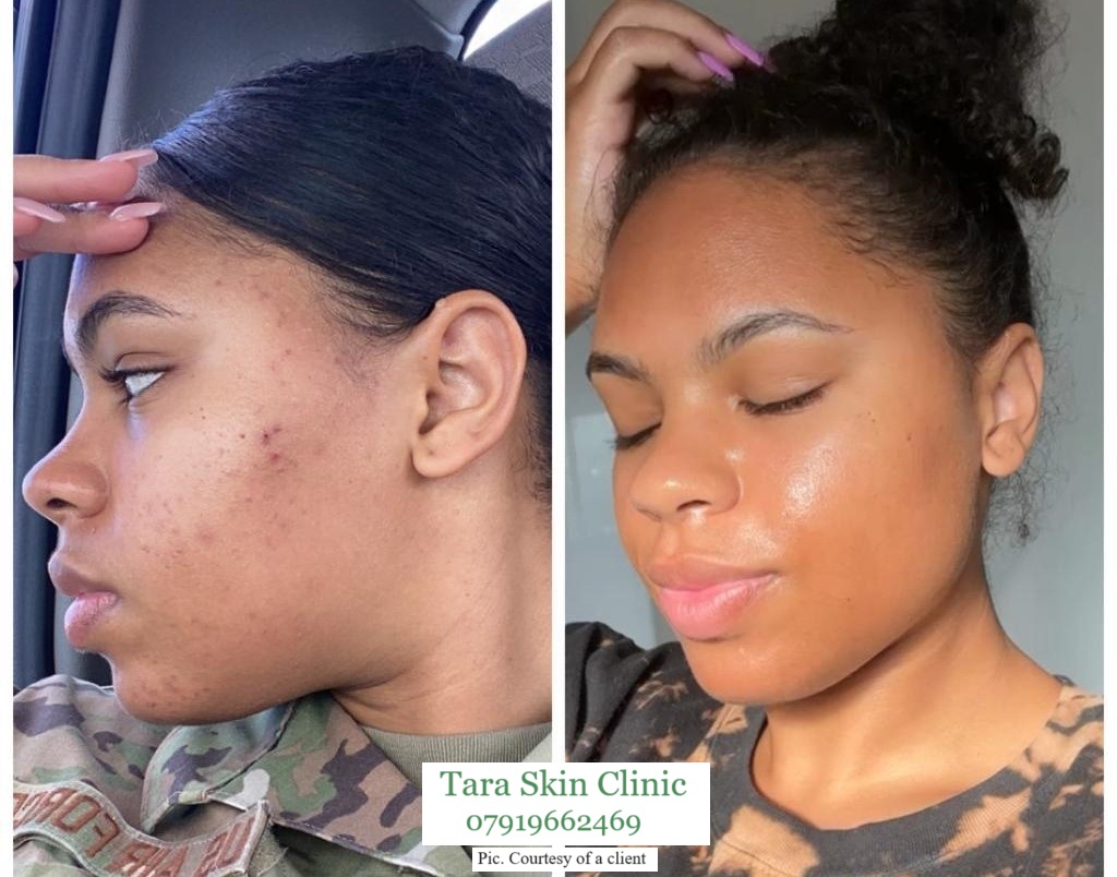 Before and after acne and acne scarring clearance treatment at Tara Skin Clinic in Newmarket Suffolk