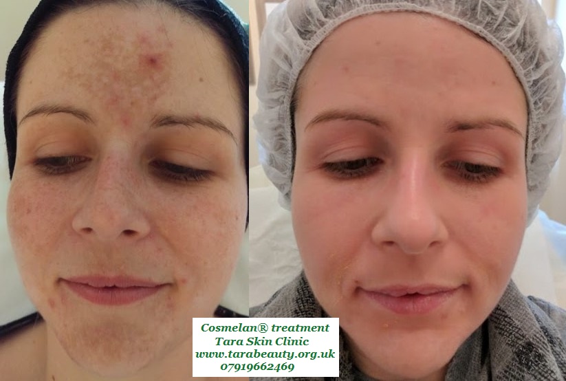 Before and after skin hyperpihmentation, melasma, treatment at Tara Skin Clinic in Newmarket Suffolk. service for Ely, Soham, Cambridge, Redlodg, Mildenhall, Lakenheath.