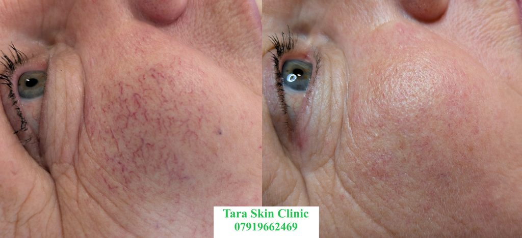 Before and after advanced skin blemish removal, telangiectasia, thread veins, treatment at Tara Skin Clinic in Newmarket Suffolk. Covering Cambridge, Soham, Ely, Redlodge, Bury St Edmunds, Lakenheath, Mildenhal.
