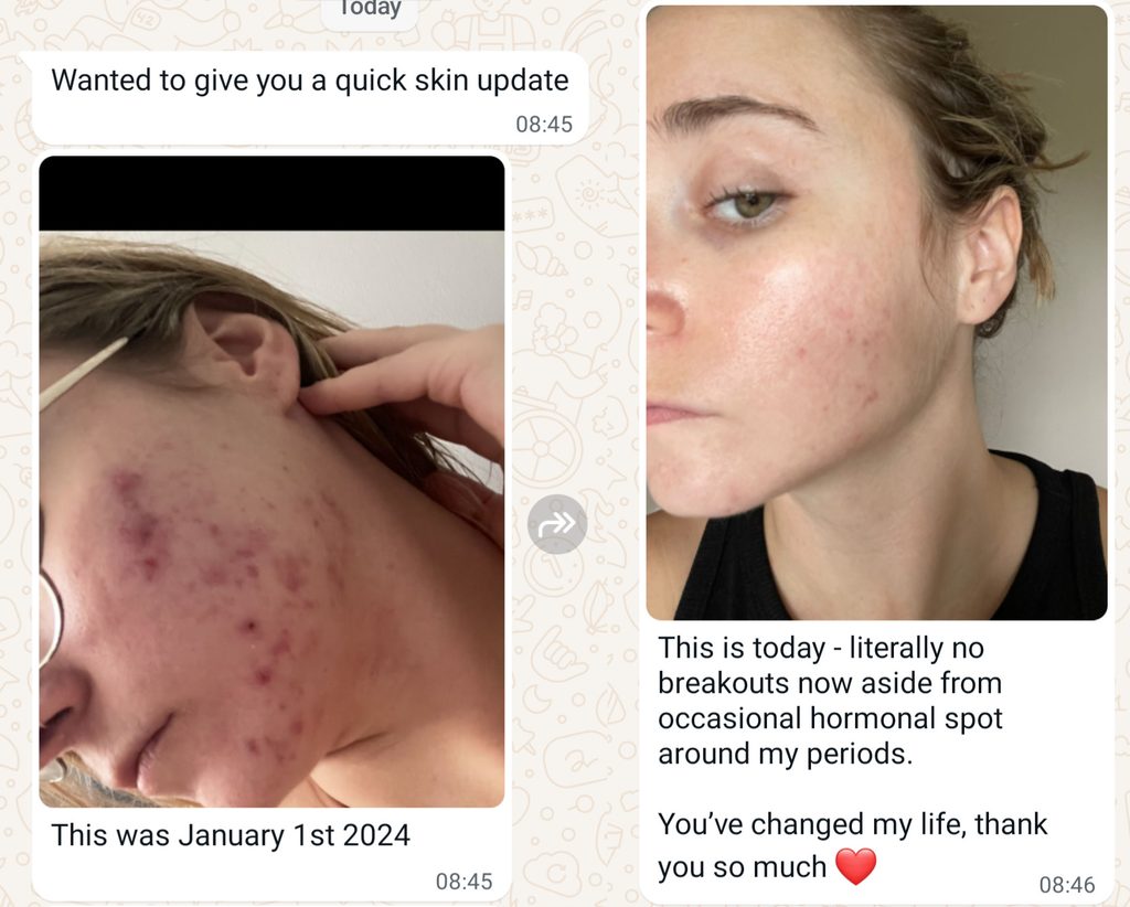 Before and after acne clearance treatment at Tara Skin Clinic in Newmarket Suffolk