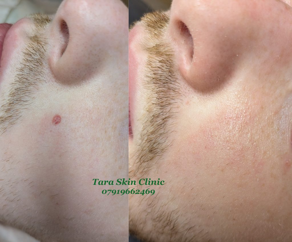 Before and after advanced skin blemish removal, blood spot, cherry angioma treatment at Tara Skin Clinic in Newmarket Suffolk covering Ely, Cambridge, Mildenhall, Lakenheath, Soham, Redlodge.
