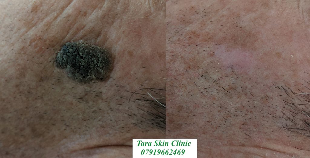 Before and after advanced skin blemish removal Seborrhoeic keratoses, warts, treatment at Tara Skin Clinic in Newmarket Suffolk. service for Ely, Soham, Cambridge, Redlodg, Mildenhall, Lakenheath.
