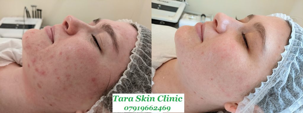 Before and after acne and acne scarring clearance treatment at Tara Skin Clinic in Newmarket Suffolk, Lakenheath, Mildenhall, Redlodge, Norfolk, ethnic skin.