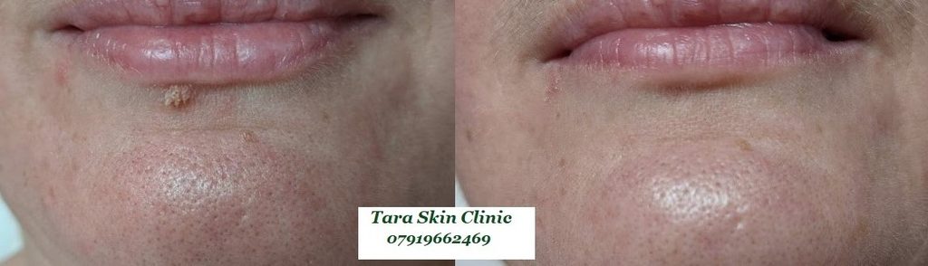 Before and after advanced skin blemish removal Seborrhoeic keratoses, warts, treatment at Tara Skin Clinic in Newmarket Suffolk. service for Ely, Soham, Cambridge, Redlodg, Mildenhall, Lakenheath.