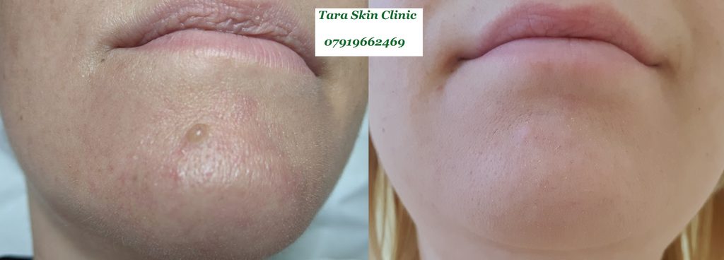 Before and after advanced skin blemish removal mole removal treatment at Tara Skin Clinic in Newmarket Suffolk. service for Ely, Soham, Cambridge, Redlodg, Mildenhall, Lakenheath.