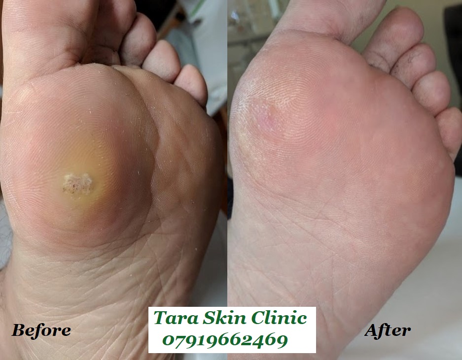 wart removal. Skin blemish removal in Newmarket, near Cambridge, Soham, Ely, Burwell
