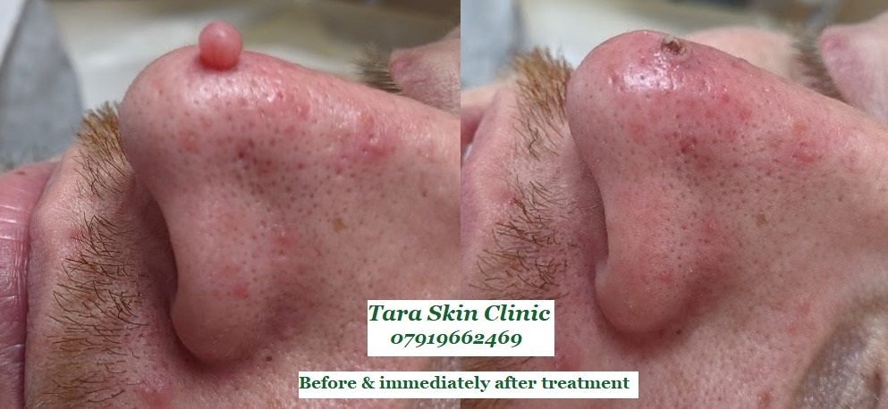 Before and after advanced skin blemish removal, fibrous papule of the nose, Seborrhoeic keratoses, warts, treatment at Tara Skin Clinic in Newmarket Suffolk. service for Ely, Soham, Cambridge, Redlodg, Mildenhall, Lakenheath.  NHS 
