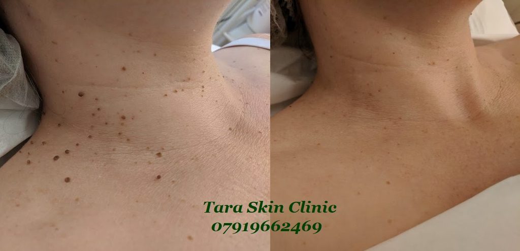 Before and after advanced skin blemish removal, skin tags, Seborrhoeic keratoses treatment at Tara Skin Clinic in Newmarket Suffolk. service for Ely, Soham, Cambridge, Redlodg, Mildenhall, Lakenheath.