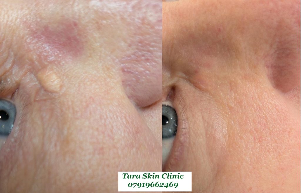 Before and  after xanthelasma removal. Before and after advanced skin blemish removal Seborrhoeic keratoses, warts, treatment at Tara Skin Clinic in Newmarket Suffolk. service for Ely, Soham, Cambridge, Redlodg, Mildenhall, Lakenheath.