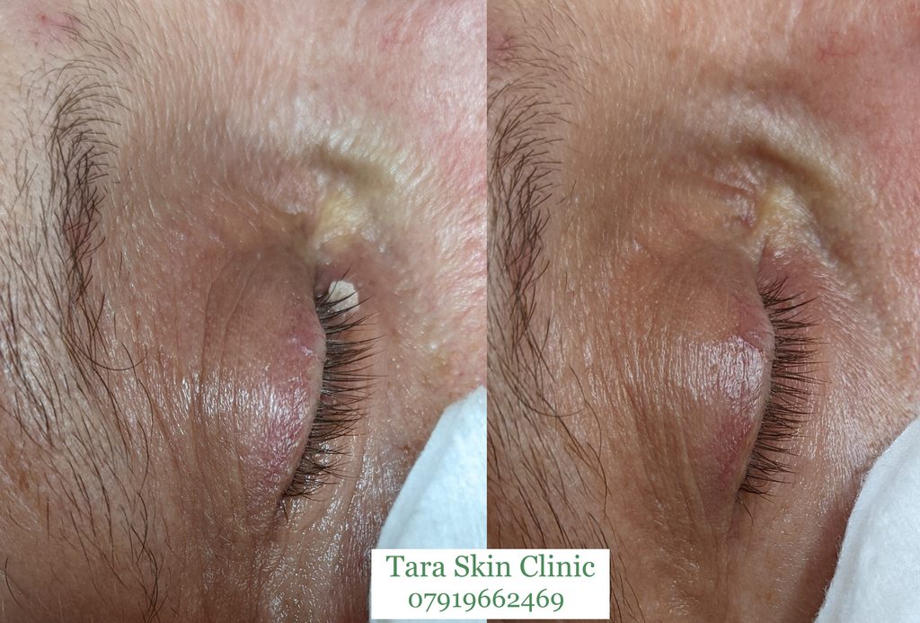 Before and after advanced skin blemish removal eye tags removal, milia removal, treatment at Tara Skin Clinic in Newmarket Suffolk. service for Ely, Soham, Cambridge, Redlodg, Mildenhall, Lakenheath.