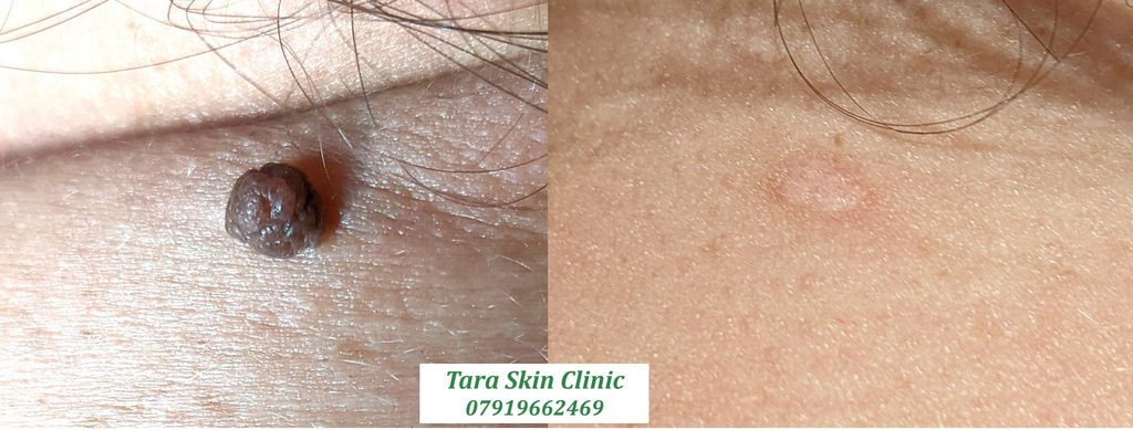 Before and after advanced skin blemish removal, mole removal at Tara Skin Clinic in Newmarket Suffolk. service for Ely, Soham, Cambridge, Redlodg, Mildenhall, Lakenheath.