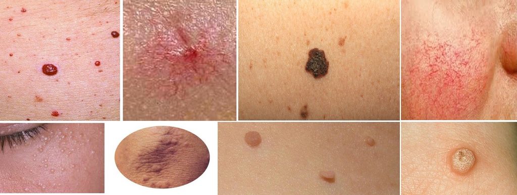 skin blemishes