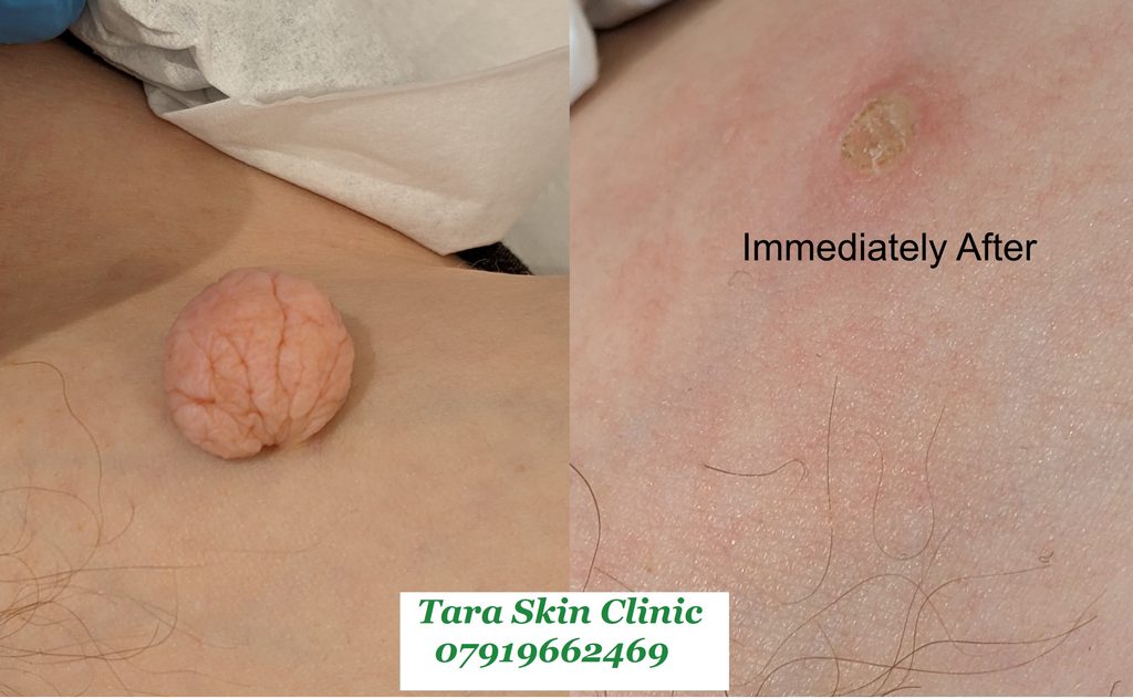 skin tag removal. Blemish removal skin clinic located in Newmarket. Covering Soham, Ely, Cambridge, Mildenhall, Lakenheath, Burwell, Fordham. 