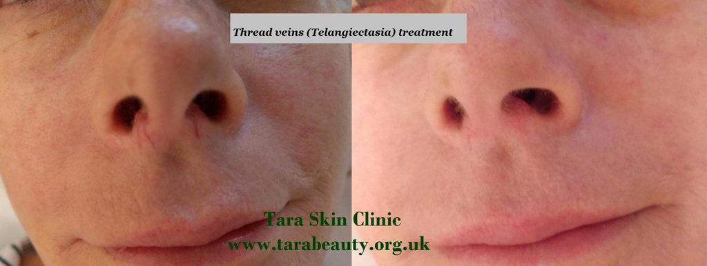 thread vein removal. Before and after skin blemish removal. Newmarket, Cambridge, Haverhill. 