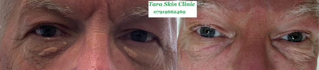 xanthelasma treatment. Skin blemish removal clinic. Newmarket, Soham, Ely, Fordham, Burwell, Lakenheath, Redlodge, Mildenhall. NHS patient
