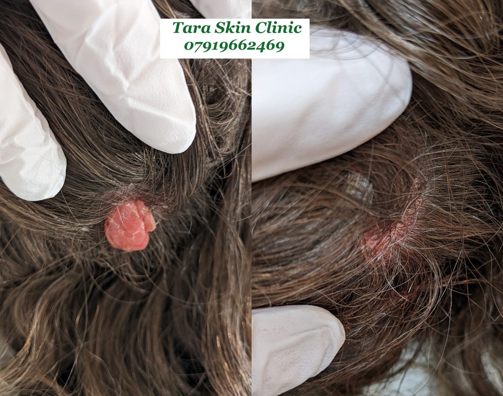 skin tag removal. Blemish removal skin clinic located in Newmarket. Covering Soham, Ely, Cambridge, Mildenhall, Lakenheath, Burwell, Fordham. 