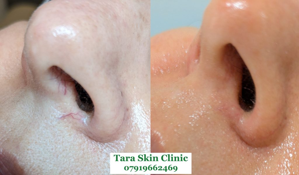 Before and after advanced skin blemish removal, thread veind, broken veins, treatment at Tara Skin Clinic in Newmarket Suffolk. service for Ely, Soham, Cambridge, Redlodg, Mildenhall, Lakenheath.