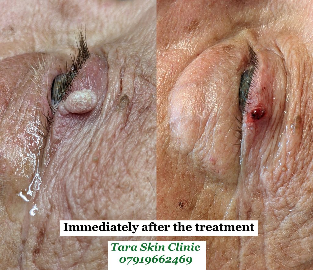 Before and after advanced skin blemish removal Seborrhoeic keratoses, warts, treatment at Tara Skin Clinic in Newmarket Suffolk. service for Ely, Soham, Cambridge, Redlodg, Mildenhall, Lakenheath.