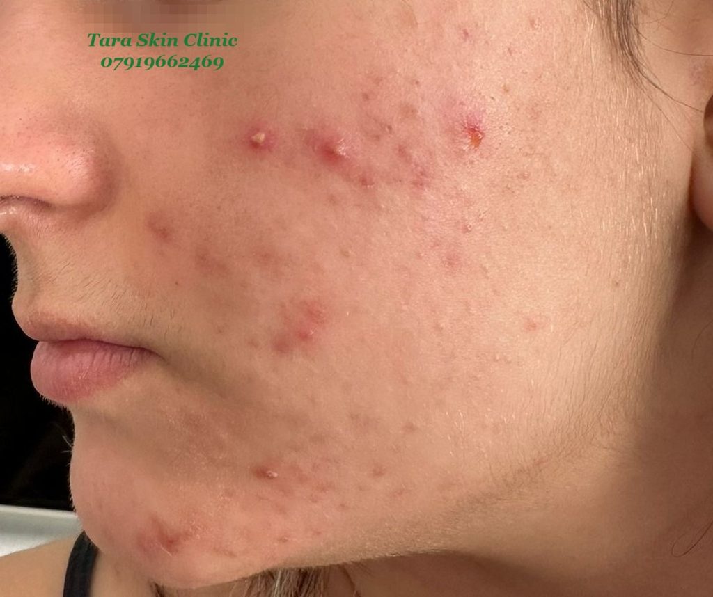 Personalised Skin Treatments Before and after teenage acne clearance treatment at Tara Skin Clinic in Newmarket Suffolk serving Soham, Ely, Mildenhall, Lakenheath, Havehill, Burwell, Fordham and Cambridge