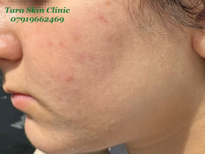 Personalised Skin Treatments Before and after teenage acne clearance treatment at Tara Skin Clinic in Newmarket Suffolk serving Soham, Ely, Mildenhall, Lakenheath, Havehill, Burwell, Fordham and Cambridge