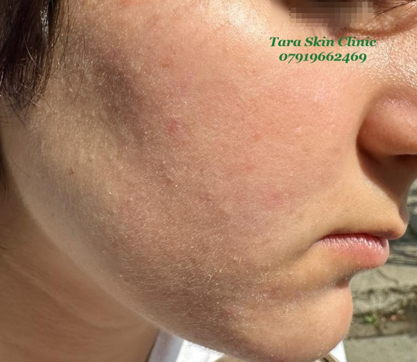 Personalised Skin Treatments Before and after teenage acne clearance treatment at Tara Skin Clinic in Newmarket Suffolk serving Soham, Ely, Mildenhall, Lakenheath, Havehill, Burwell, Fordham and Cambridge.