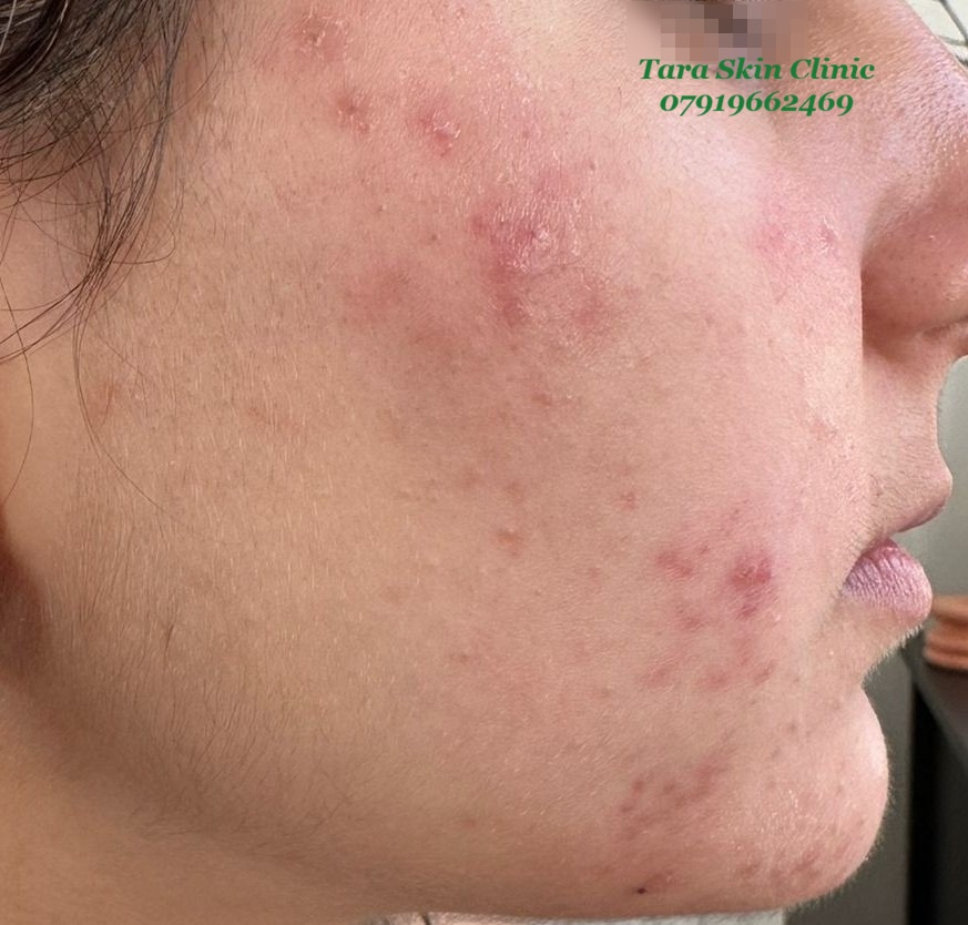 Personalised Skin Treatments Before and after teenage acne clearance treatment at Tara Skin Clinic in Newmarket Suffolk serving Soham, Ely, Mildenhall, Lakenheath, Havehill, Burwell, Fordham and Cambridge.