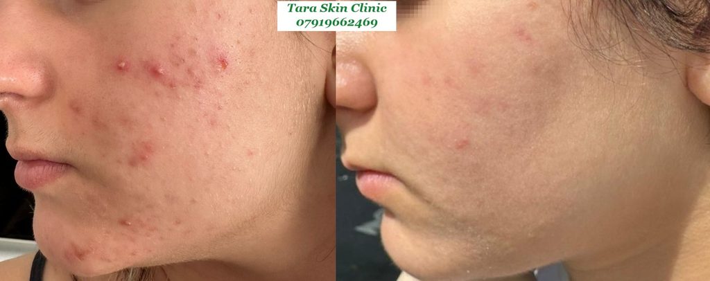 Personalised Skin Treatments Before and after teenage acne clearance treatment at Tara Skin Clinic in Newmarket Suffolk.