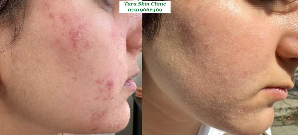 Personalised Skin Treatments Before and after teenage acne clearance treatment at Tara Skin Clinic in Newmarket Suffolk serving Soham, Ely, Mildenhall, Lakenheath, Havehill, Burwell, Fordham and Cambridge